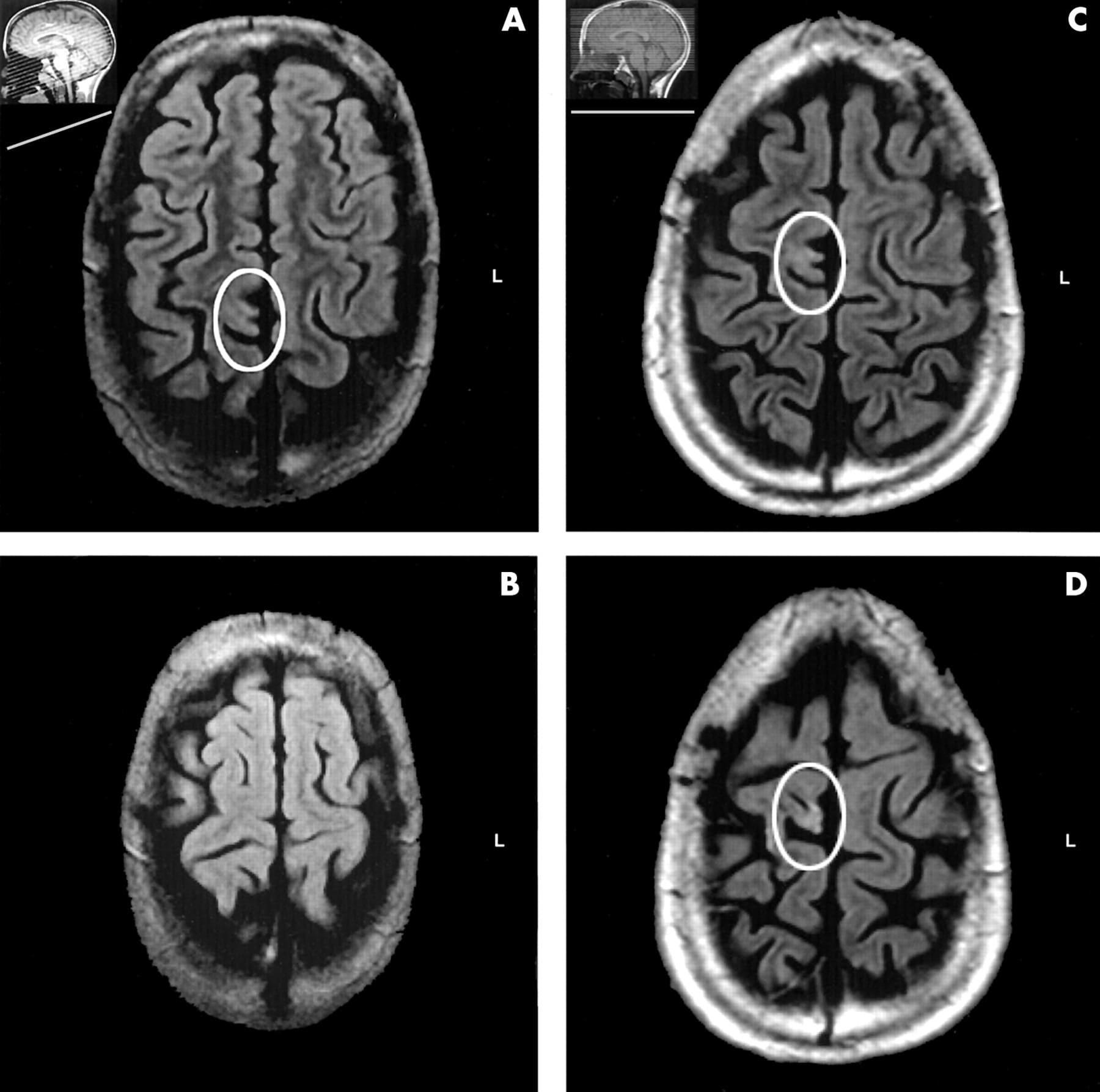 эпилепсия на МРТ головного мозга